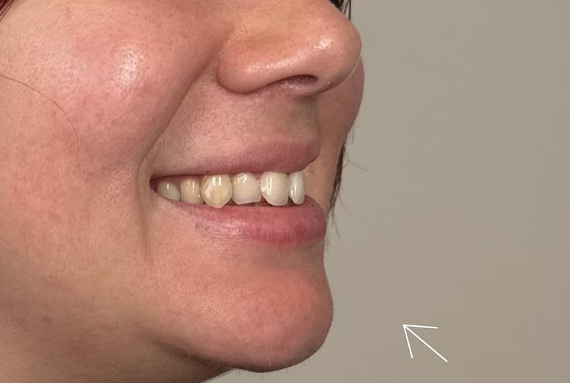 Lip Fillers Before & After