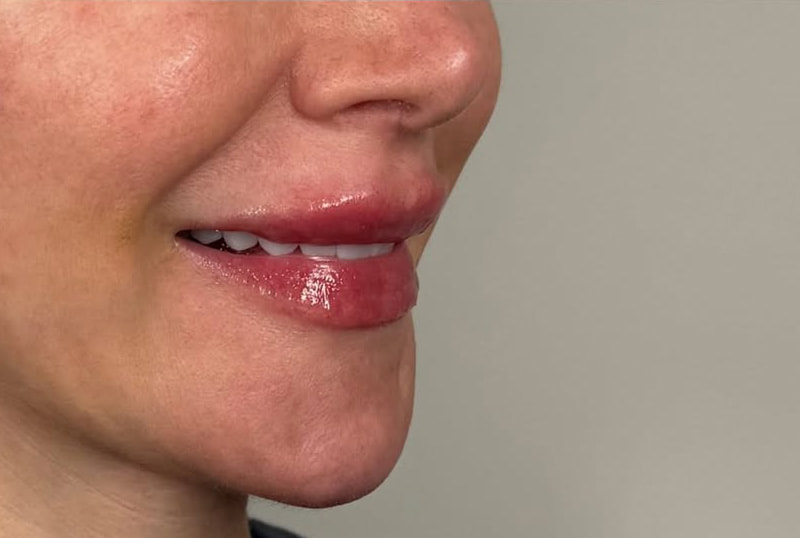 Lip Fillers Before & After Image