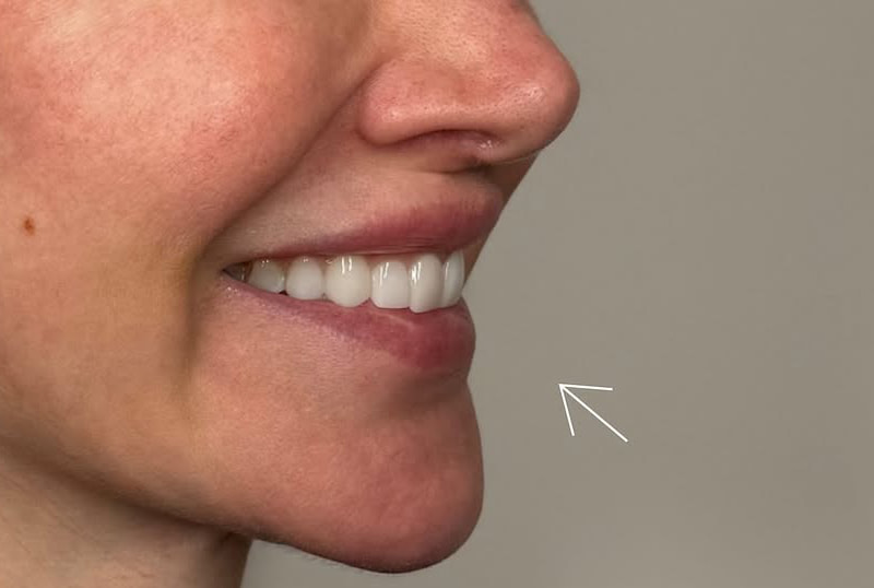 Lip Fillers Before & After