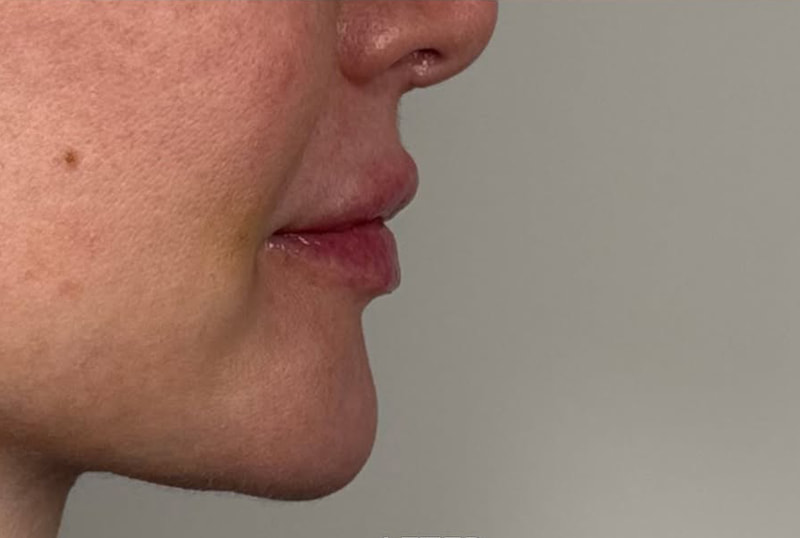 Lip Fillers Before & After Image