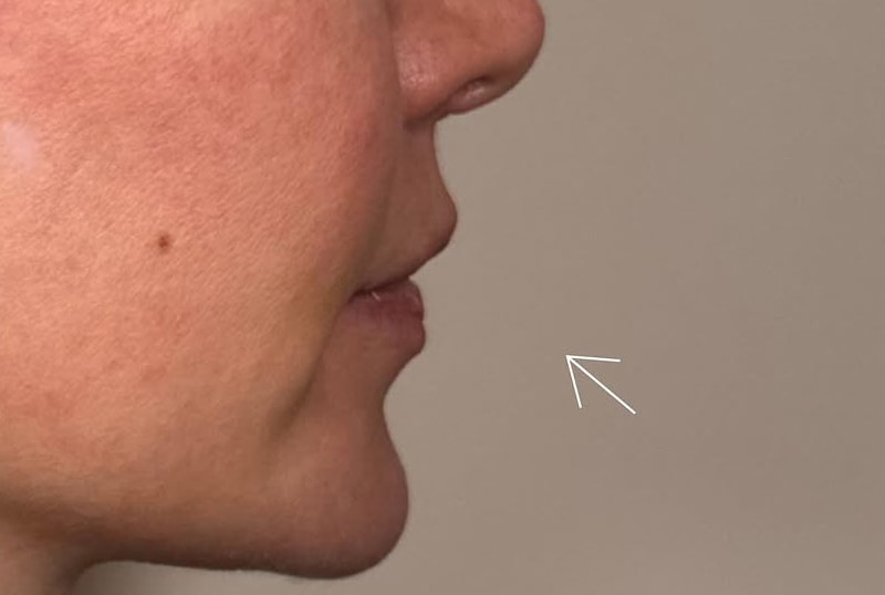Lip Fillers Before & After