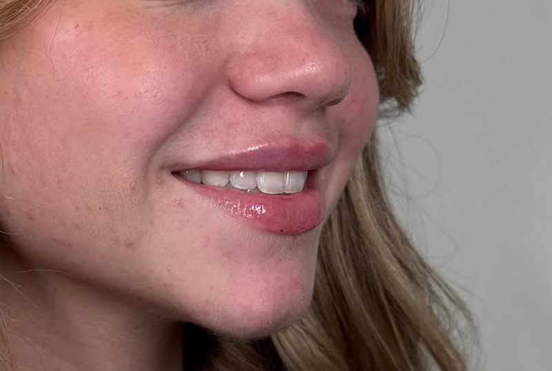 Lip Fillers Before & After Image