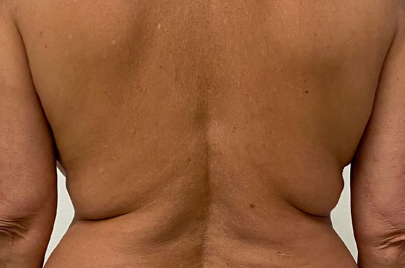 Morpheus8 Before & After