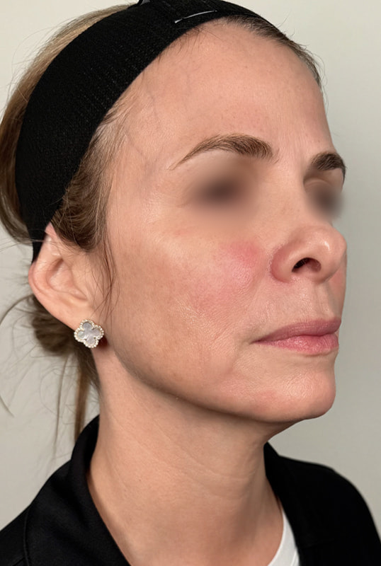 Sculptra Before & After Image
