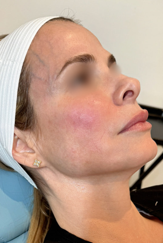 Sculptra Before & After