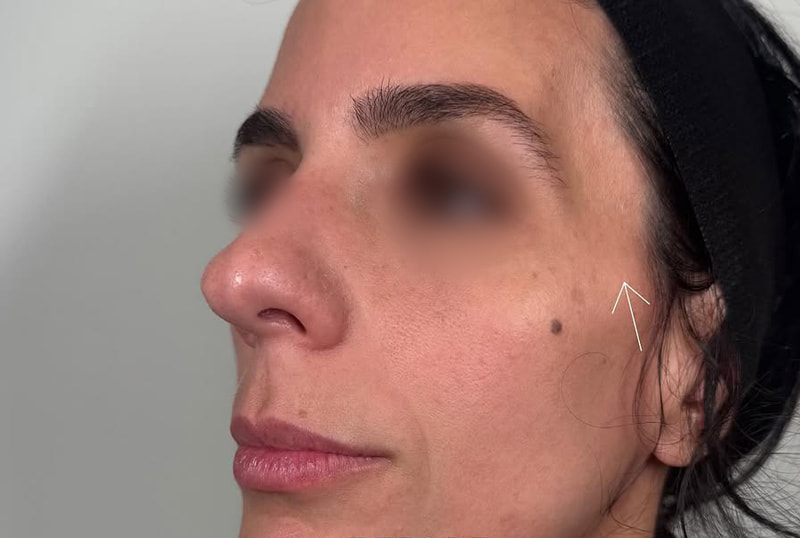 Temple Fillers Before & After Image