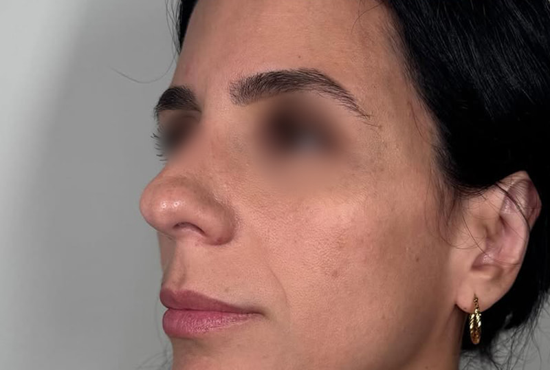 Temple Fillers Before & After Image